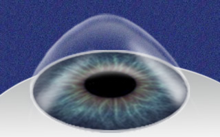 keratoconus