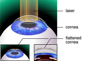 Prk laser deals
