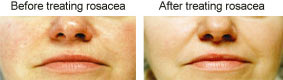 Dry Eye Treatment Carlsbad